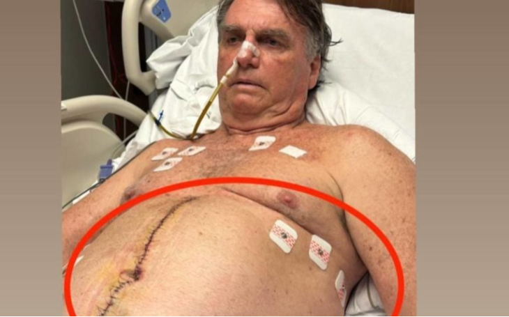 Ainda internado, Bolsonaro posta foto de pontos da cirurgia e dreno